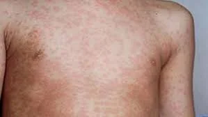 Health alert issued for measles outbreak in Australia’s Victoria state